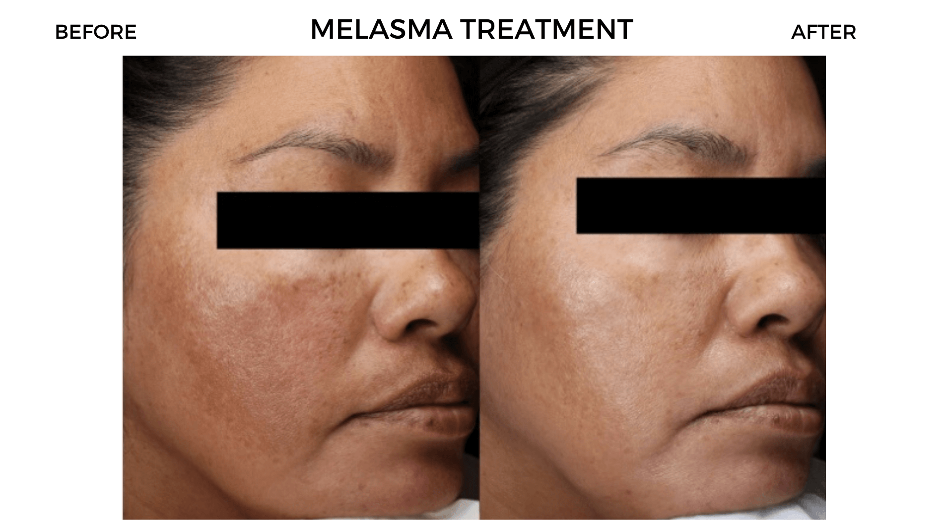 Melasma Treatment